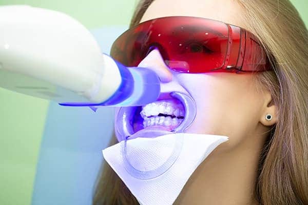 Laser teeth whitening treatments Peterborough