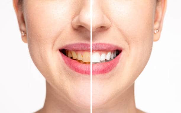 Teeth Whitening Milton Keynes Peterborough