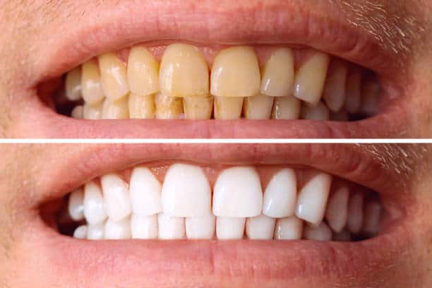 Laser White For Ever Bright – Get a Brighter, Whiter Smile with LA Teeth Whitening Peterborough