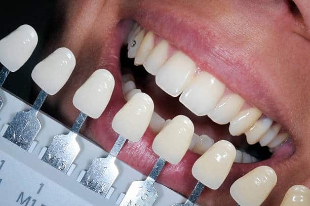 Get Natural and Stunning Smile with Teeth Whitening Results from LA Teeth Whitening Peterborough