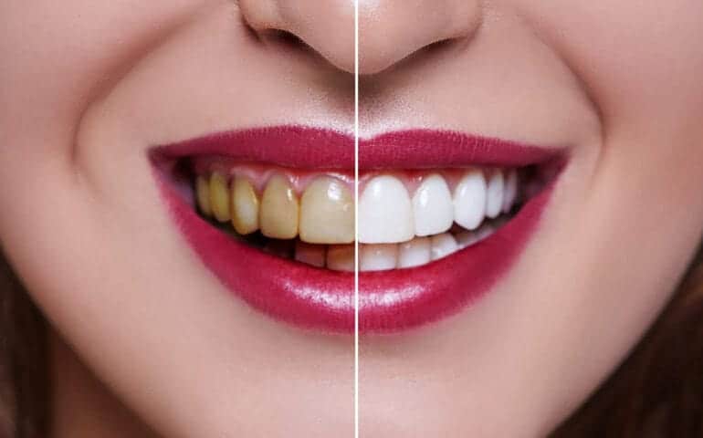 Teeth Whitening Ascot Windsor Peterborough