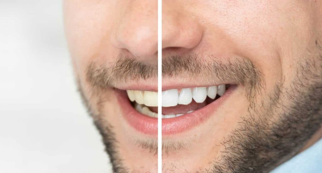 Teeth Whitening Bedfordshire Peterborough