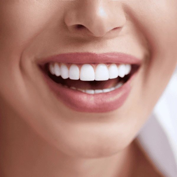 Get A whiter smile fast! Book with LA Teeth Whitening today! Peterborough